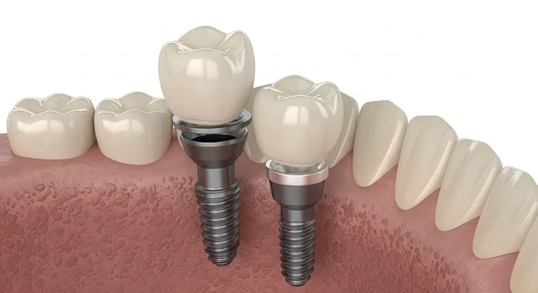 8 Signs You Need Dental Implants:Expert Oral Health Guide