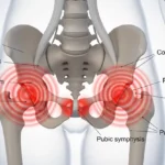 Pelvic Girdle Pain