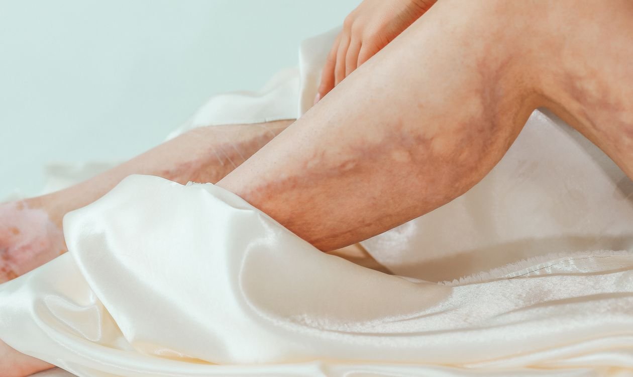 Close-up of bruises on a person's leg